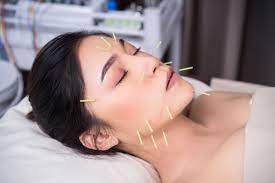 Is acupuncture useful?
