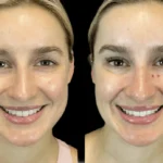 H4-Botox-1.webp