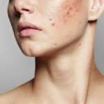 Laser-Acne-Scar-Treatment-in-Abu-Dhabi-Clear-Skin-Guaranteed.png