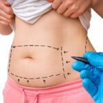 Tighten-Loose-Skin-with-a-Tummy-Tuck.jpg