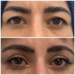 V-upper-eyelid-1.webp