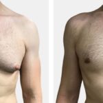 gynecomastia-surgery-in-dubai-abu-dhabi-sharjah.jpg