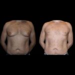 male-breast-surgery-2-1-1-1-1-3.jpg