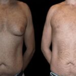 male-breast-surgery-3.jpg