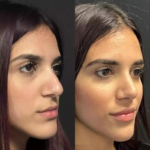 rhinoplasty-in-dubai-3.png