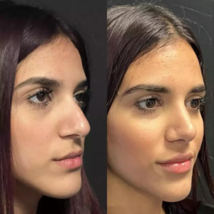 The Cost of Nose Surgery in Dubai: What to Expect