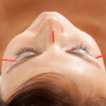 cosmetic-acupuncture-600x409-1.jpg