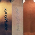 Fresh-Starts-For-Your-Skin-Laser-Tattoo-Removal-And-Inkless-Tattoos-In-London-And-Brentwood.jpg