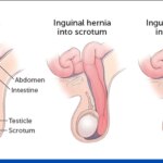 Inguinal-Hernia-Surgery.jpg