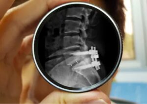 Spinal Stenosis | Causes, Symptoms & Treatment Options