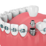 Dental-implants-in-Riyadh-8.jpg