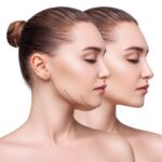 Double-Chin-Removal-in-Islamabad.jpg