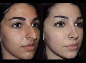 Rhinoplasty in Dubai: Transform Your Nose, Transform Your Life