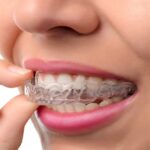 teeth-aligners-in-Islamabad-pakistan.jpg