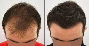 Hair Transplant in Lahore: A Complete Guide to Cost, Clinics, and Procedures