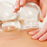 Cupping NYC/Cupping Therapy NYC