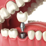 Dental-implants-in-Riyadh-4.jpg