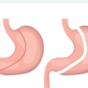 Common Myths About Gastric Sleeve Surgery in Riyadh Debunked