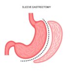 Gastric-sleeve-surgery-in-Riyadh-24.jpg