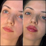 H5-lip-fillers.jpg