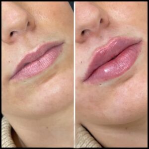 Lip Fillers Done Right: Best Doctors in Dubai to Choose