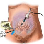 Laparoscopic-surgery-in-Riyadh-1.gif