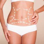 Liposuction-surgery-in-Riyadh-22.jpg