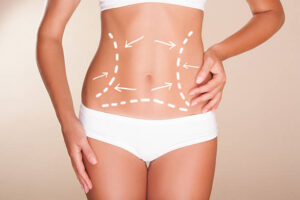 Achieve a Flatter Stomach with Liposuction Surgery in Riyadh