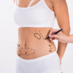 Liposuction-surgery-in-Riyadh-35.jpg