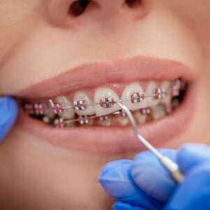 Orthodontics in Riyadh: Everything You Need to Know