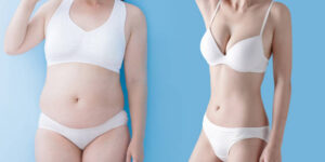 Tummy Tuck in Riyadh: Transform Your Body with Expert Care