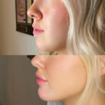 chin-filler-phoenix-arizona-2-jpg-1.png
