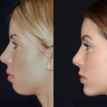 chin-implant-surgery-dubai.jpg