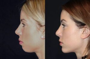 Get Sculpted with the Best Plastic Surgeons in dubai for Chin Fillers