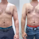 gynecomastia-surgery-98-front-detail.webp