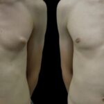 gynecomastiaperfectdoctorsclinic-ezgif.com-webp-to-jpg-converter.jpg