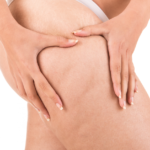 A-Guide-to-Cellulite-Removal-Procedures.png