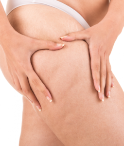 A Guide to Cellulite Removal Procedures