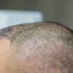 FUT-vs.-FUE-Hair-Transplant-Which-is-Best-for-You.jpg