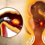 hemorrhoids-by-laser-in-riyadh-19.jpg