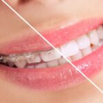 teeth-straightening-3.jpg