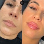 Copy-of-lip-filler-3.jpg
