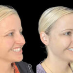 H1-Botox-1.jpg