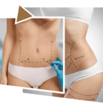 Liposuction-in-Dubai.png