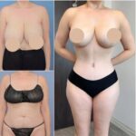 360-body-lift-results.jpg
