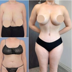 Tummy Tuck in Dubai: Why You Should Trust the Best Surgeons