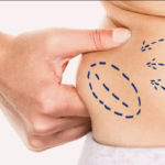 Best-Liposuction-Surgery-in-Dubai.png