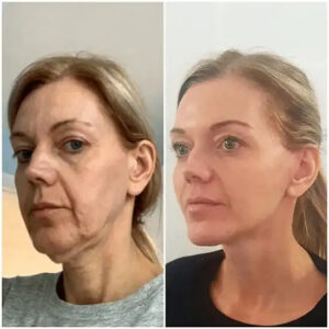 Safety First: Best Breast Augmentation Surgeons in Dubai with Proven Results