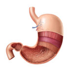 Gastric-Balloon-in-Riyadh-9.jpg
