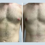 H7-Gynecomastia.webp